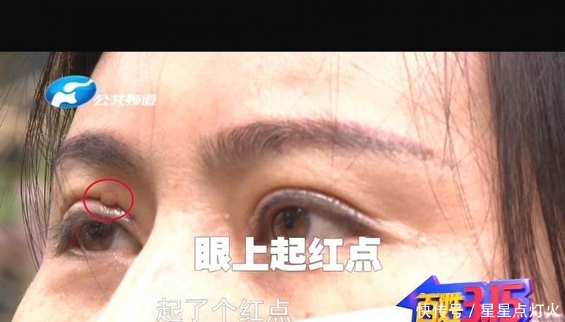  医院工作人@郑州东方整形想要修复双眼皮 谁料眼上起脓包