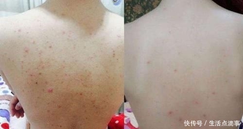  家里|家里的“硫磺皂”可以直接洗脸？没搞清楚4个作用，难怪痘痘多！