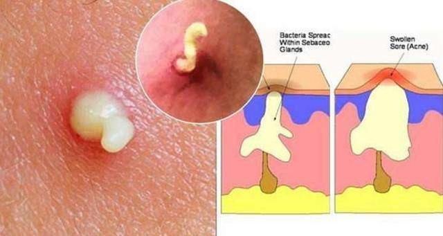 痘痘经久不消内藏“毒脓”, 2种天然物专祛痘，清空毛孔排出痘毒
