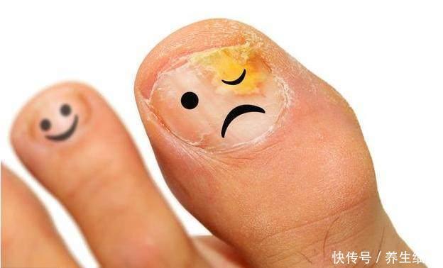 灰指甲传染性强,做好3件事,保护家人不被伤害