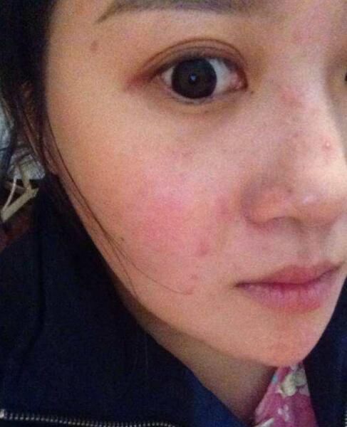 鼻子挤出的小颗粒太多，是螨虫的排泄物凝固，怎么让它们不再长？