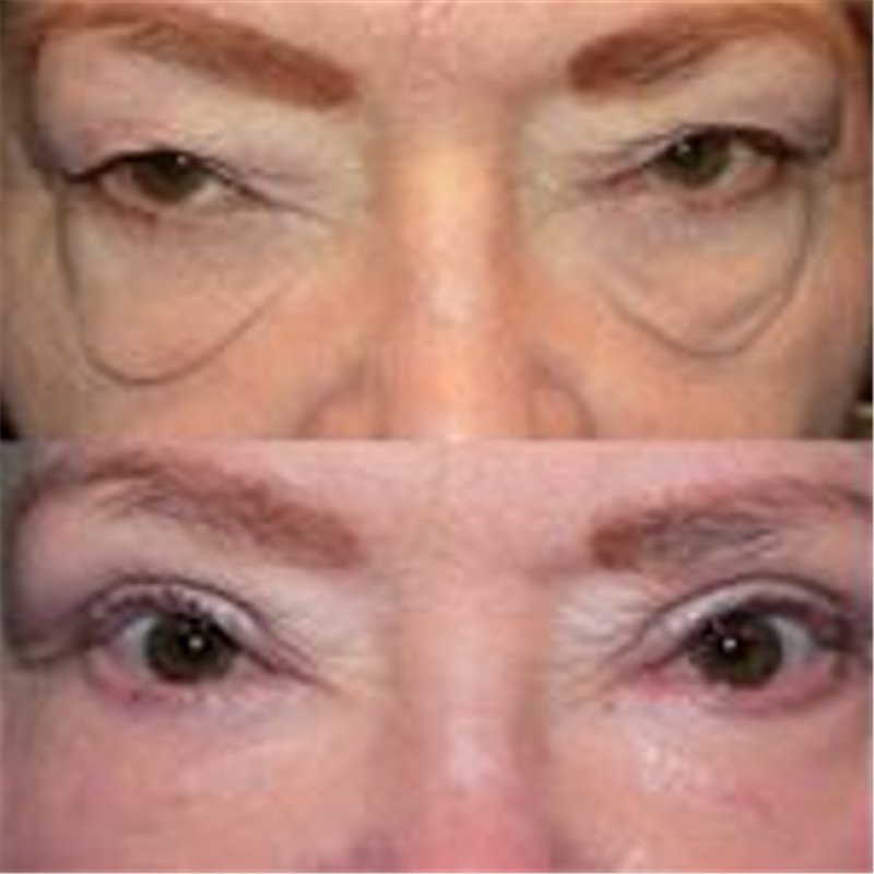 大眼袋瞬间老12岁!别依赖玻尿酸，教你一妙招，拉平眼袋显年轻