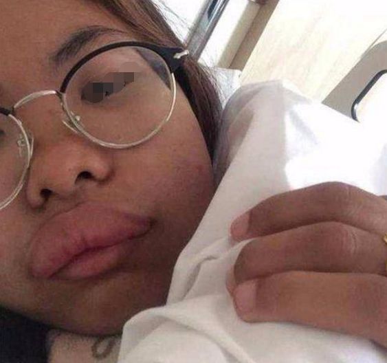 女子一觉醒来，嘴唇竟变成了“香肠”，检查后连医生都忍不住笑了