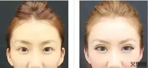 双眼皮贴的三大危害，你知道吗？