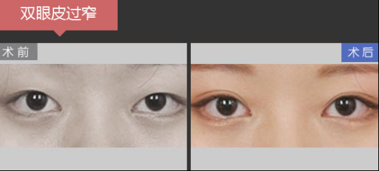 深圳美莱梁志为眼修复案例,她们实现惊艳蜕变