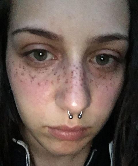  手术：英女子痴迷梅根“雀斑妆”，拙劣手术让面部毁容，花3万治疗修复