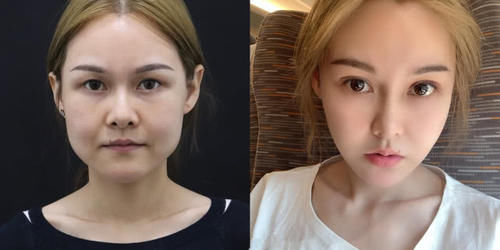  #术后恢复#为什么说春季是医美旺季？最适合整形项目大盘点，必看！