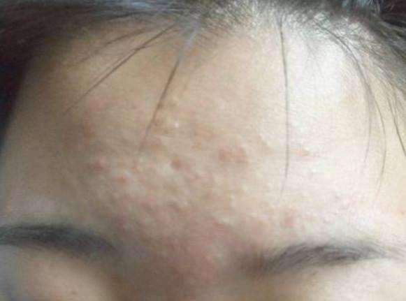 脸上起这种疙瘩, 会痒, 抓破后还能掉出硬邦邦米粒, 居然是这3物