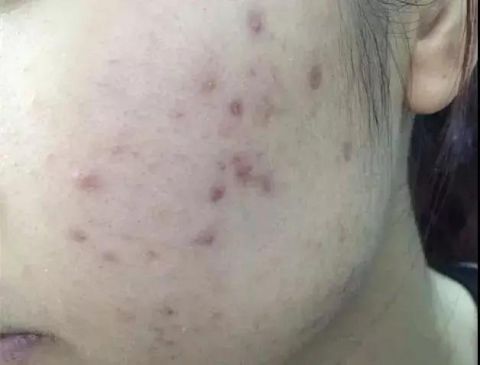  『黑色痘印』青春不再痘印难消，满脸黑红痘印的你该让皮肤干净起来了！
