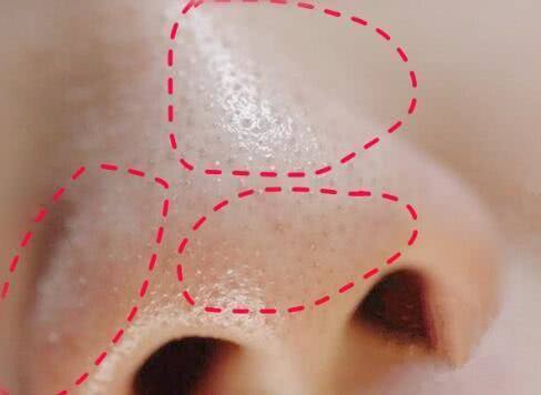 最有效去草莓鼻!5步黑头、白头、闭口立扫光!