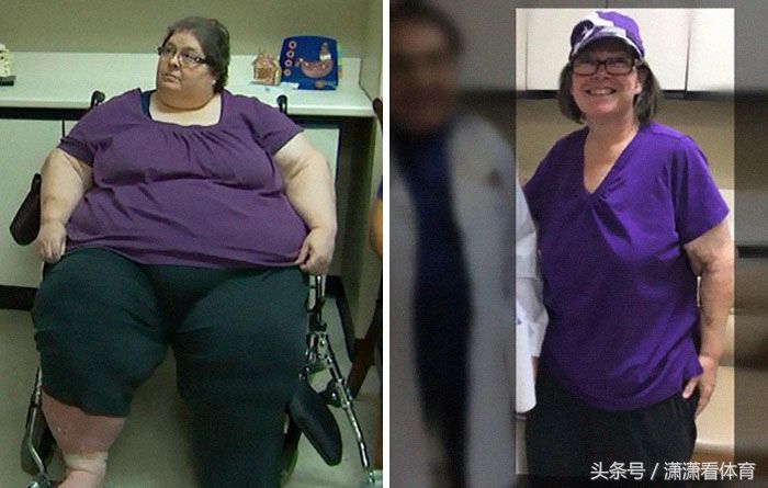这群体重超过500斤的人仍回归正常，减肥堪比整容!