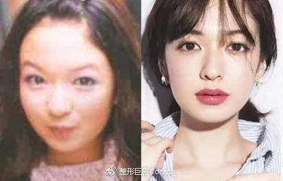 平行和扇形双眼皮该怎么选择？哪个更流行？