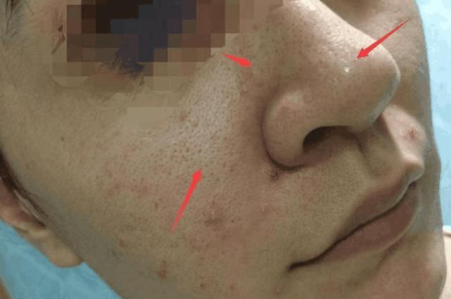 毛孔粗黑头多,示意螨虫“车载斗量”, 支配3妙招,一举歼灭螨虫