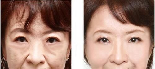 #皮肤#医生忠告女人有“眼袋”别打玻尿酸，“几毛钱药膏”搽一搽，眼袋全消
