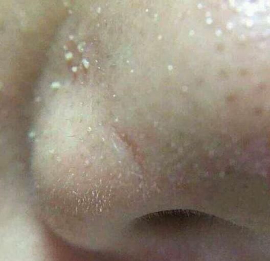 鼻子上总是挤出小米粒，因为有螨虫在钻孔，再不解决毛孔没救了