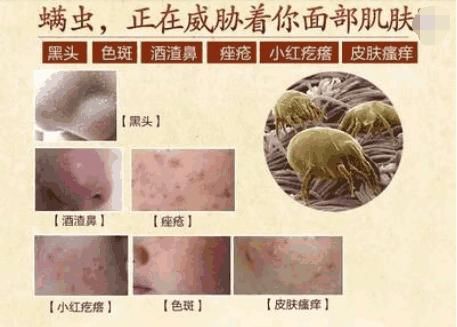 鼻头里挤出这么多“小黄粒”, 原来是脸上螨虫过亿，3招教你除螨