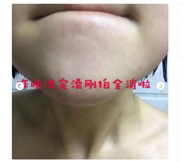 5块钱维生素B6 闭口、粉刺、痘痘统统消!好用到哭!