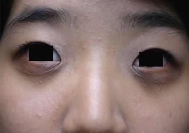 脂肪粒、眼袋救星!医学院博士说漏嘴的药膏!满满胶原蛋白