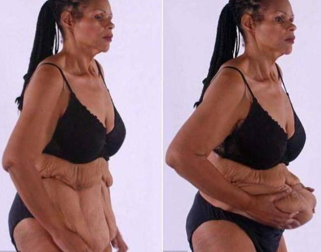 从600多斤到200多斤，减肥成功却留下一身赘皮，洗完澡都会发臭！