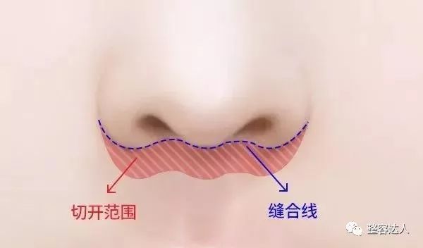  [好看]人中缩短术|你长得不好看，也许因为人中长！