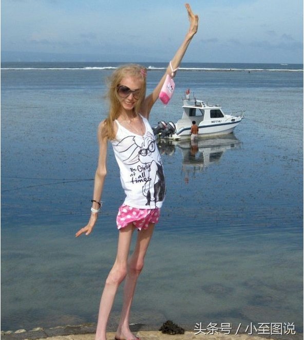 俄罗斯女子为减肥变成活骷髅，体重只剩42斤