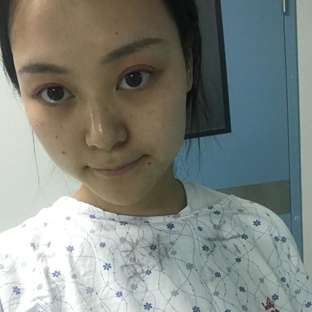 韩式双眼皮+开眼角能做出“桃花眼”吗？这篇真人案例值得参考！