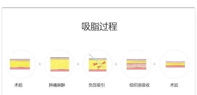 多余的脂肪■手臂吸脂效果好吗?会不会反弹?