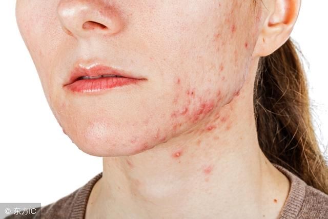 这样的痘痘肌9年了，能好吗？3个月好了，你信吗？