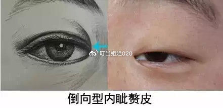  【内眦赘皮矫】需不需要看眼角……请对号入座