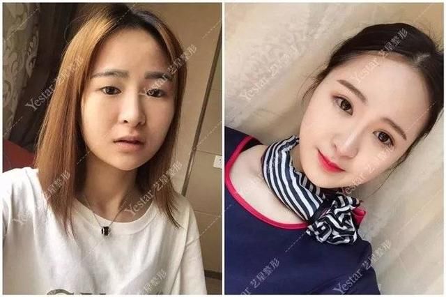  济南■「济南艺星双眼皮」别傻了！这种“无痕双眼皮”其实就是……