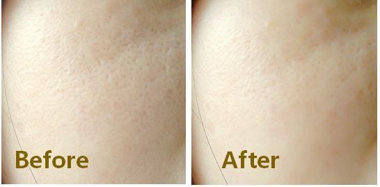 效果逆天的“收毛孔神器”，三周毛孔就变小，都说像去做了医美!