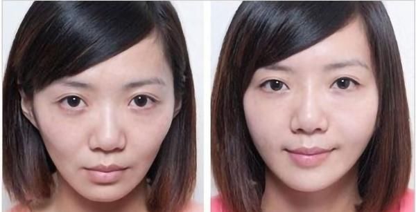  凹陷■自体脂肪填充优缺点细数，这些缺点你都知道吗，快来看看！