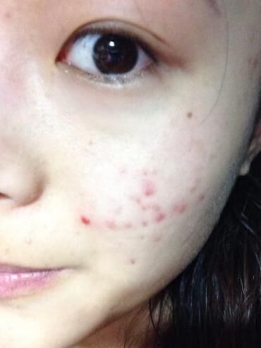 脸上螨虫过亿，除了去医院，只需一片叶子，螨虫全都死光光