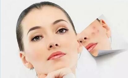 果酸换肤，让肌肤焕然新生