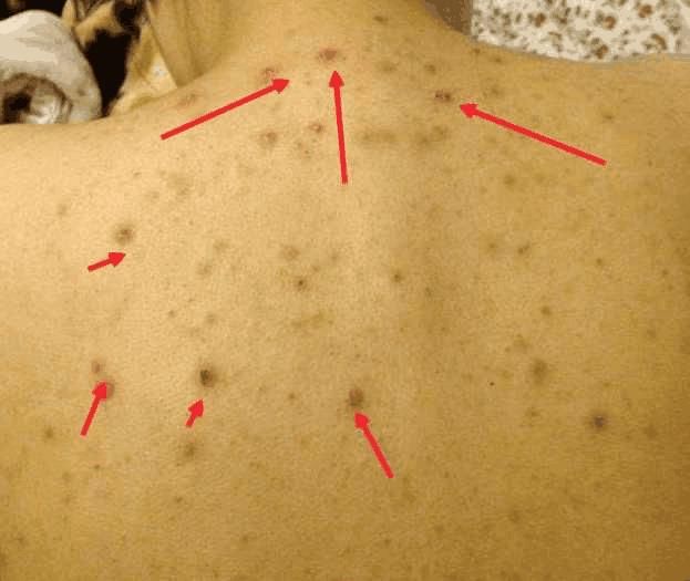 警告：后背有这5个“奇怪的现象”, 是螨虫在向你“打招呼”了