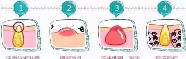 【防晒】“痘痘”想要去除并不难,能跨过这3道坎,可有效缓解