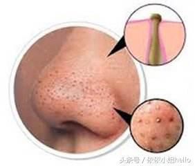 为什么你的黑头越去越多？怎么样去黑头才是正确的呢？