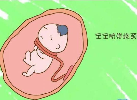 胎儿脐带绕颈一周怎么办才好 t018d44385f44557d3e.jpg
