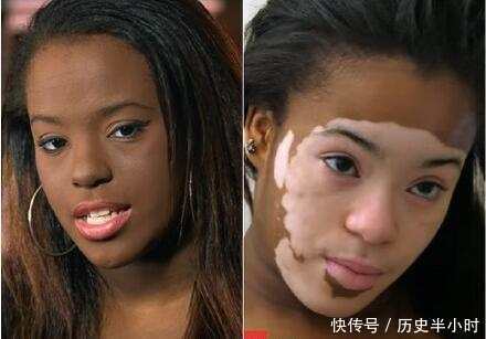 她患白斑症躲粉底下7年，当决心卸妆后，网友惊呼美呆了！