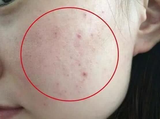 脸上感染了螨虫，会出现4现象，教你3个最佳除螨攻略