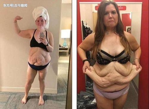 350斤胖妞减掉一半多体重，肚子留下20斤重的赘皮后悔不已！