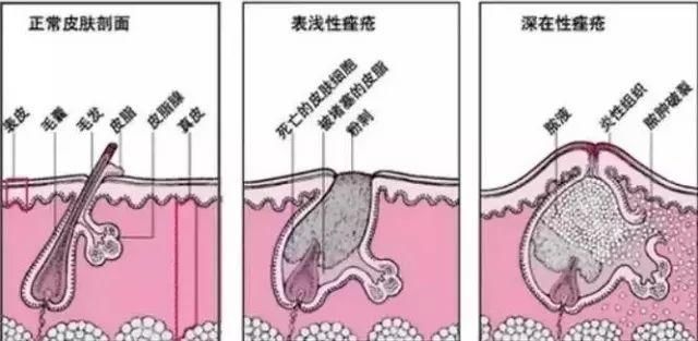 令人骄傲的“中国制造”还不多,但这中国农科院研发的抗痘神器肯