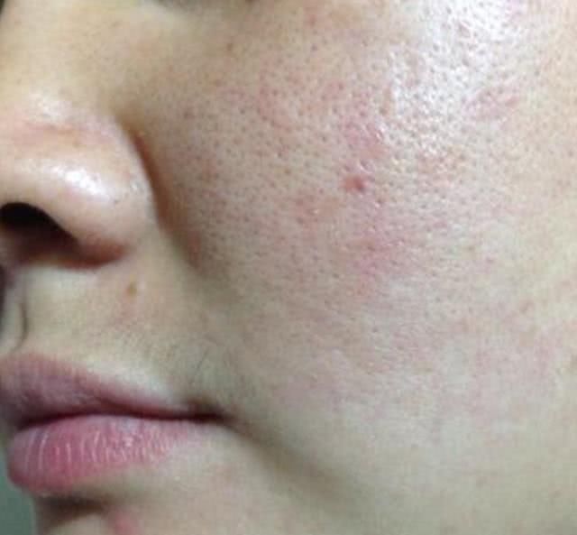 不花钱教你缩毛孔！大油田毛孔终于有治了！