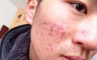 「解决」药店有款男士洗面,网友为买它日夜排队,3次解决痘痘肌问题