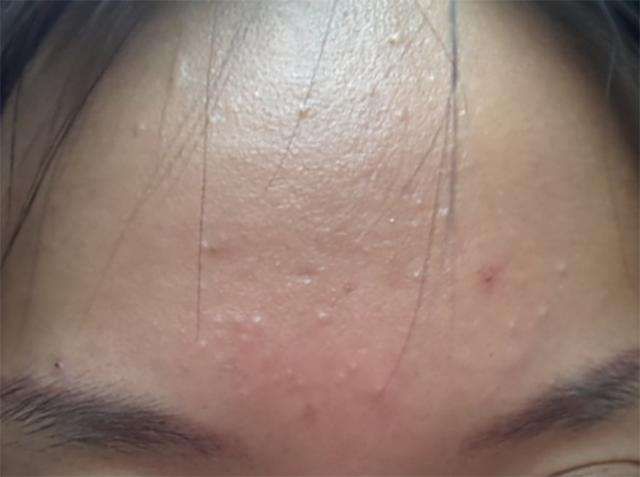 说实话:螨虫超出这个数，4个危害步步紧逼，再不除螨，脸要毁掉