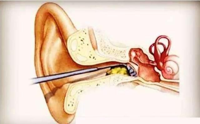 学生体检发现外耳道被耳屎堵塞?两个处理方案