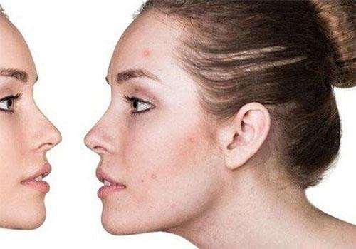 脸上螨虫爆发时有4信号，不除螨，再多护肤品都是在喂养螨虫