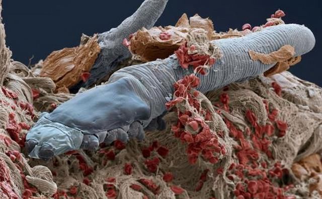 开学季被痘痘“霸占”整张脸的你，洗脸时用点“它”,7天赶跑痘痘