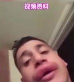  『嘴上的干皮』嘴唇干裂起皮不是缺水而是病!涂护唇膏更严重!