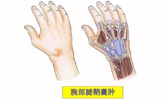 手腕长出一个疙瘩,难道是肿瘤吗?